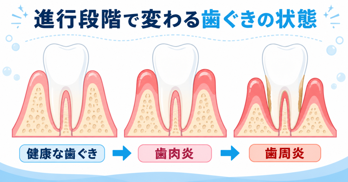 歯みがきで歯ぐきから出血する主な原因とは？