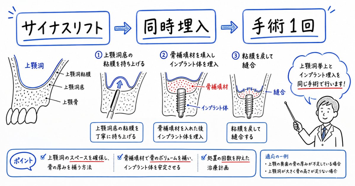 サイナスリフトと同時埋入は可能？手術を1回で終える条件を解説