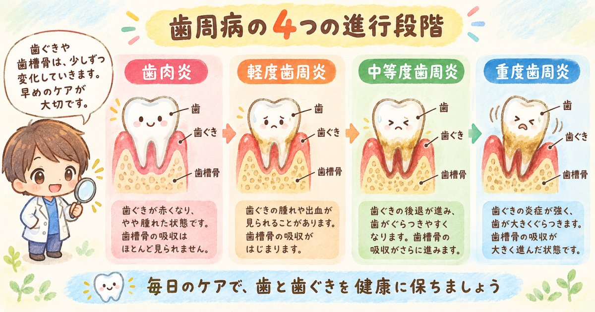 歯周病の進行段階と症状：歯肉炎から重度歯周炎までのサイン